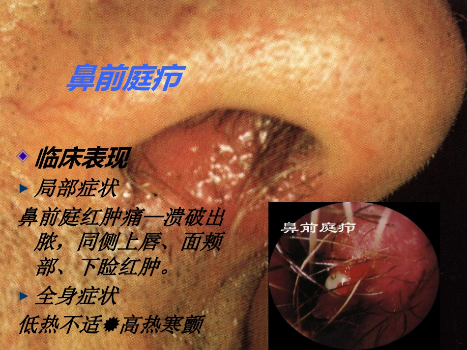鼻部疾病(1)_第10页