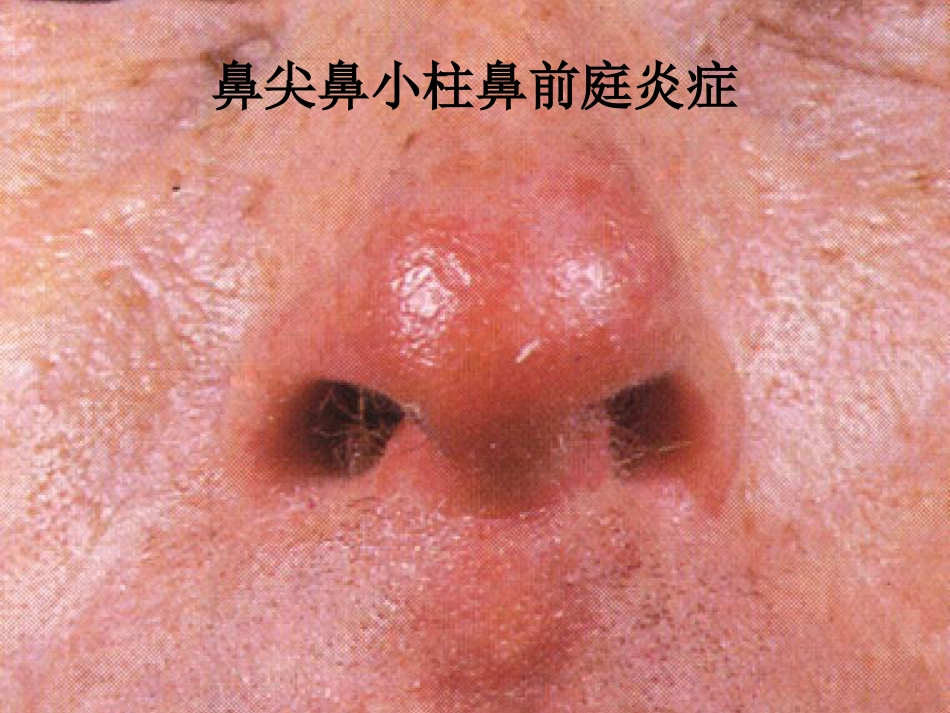 鼻部疾病(1)_第12页