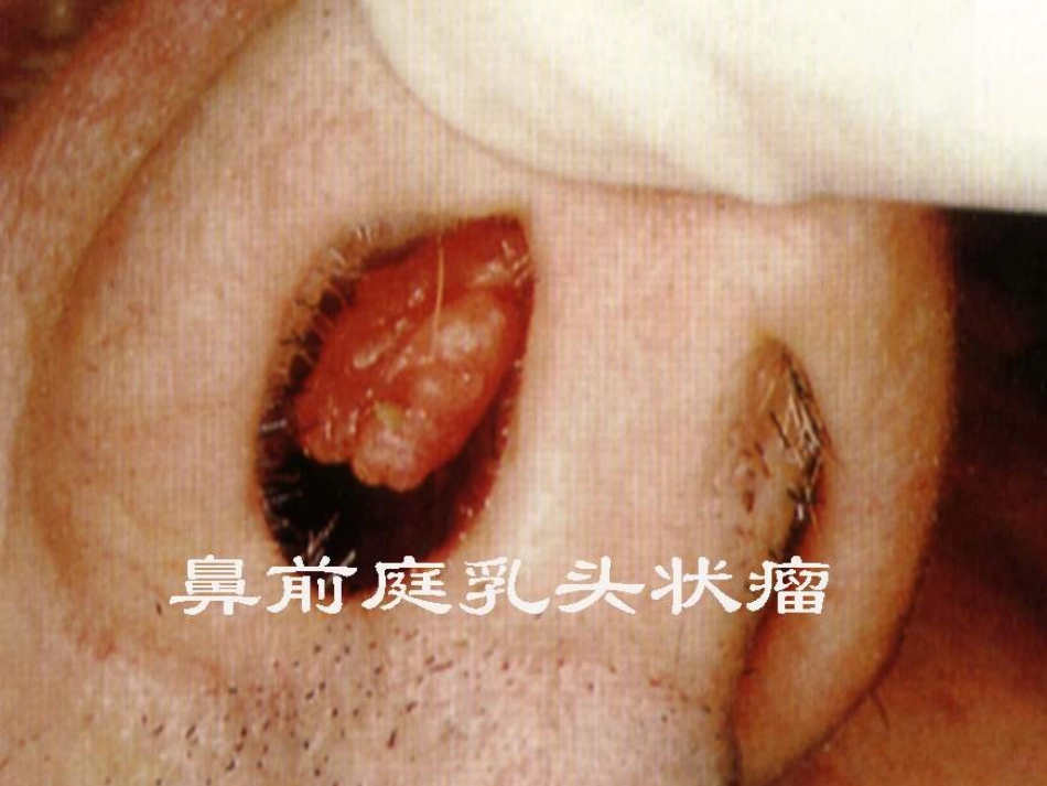 鼻部疾病(1)_第13页