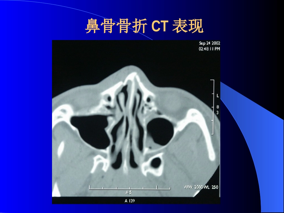 鼻部疾病(1)_第4页