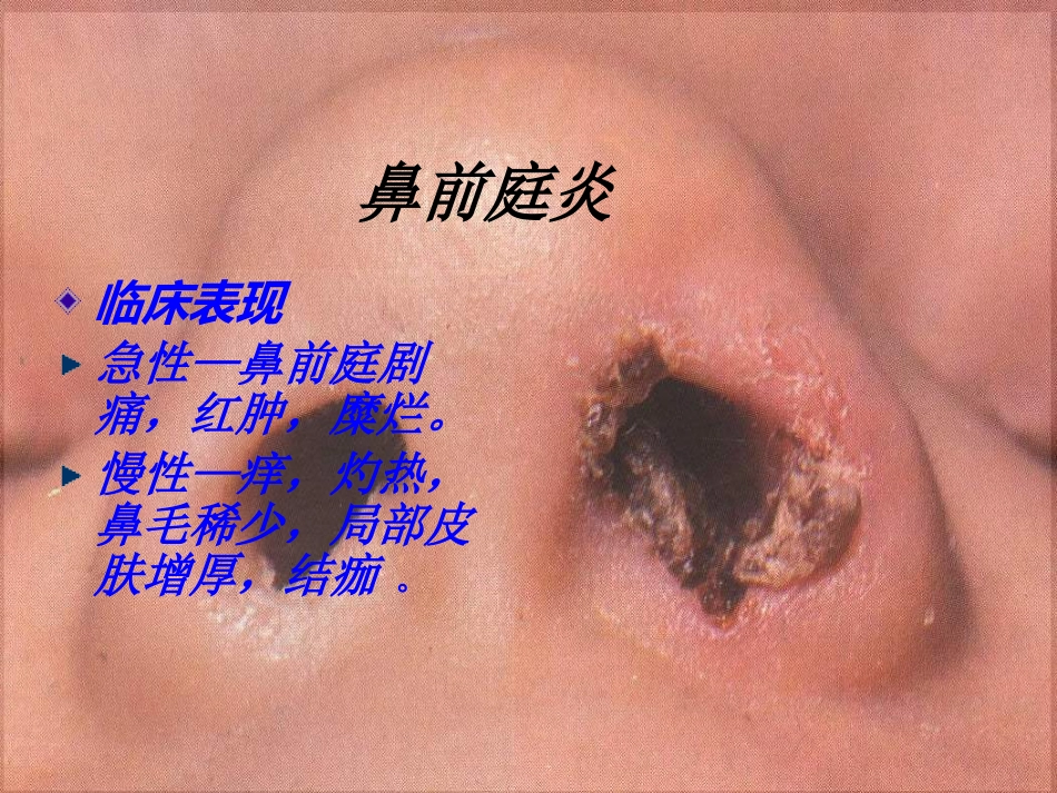 鼻部疾病(1)_第7页