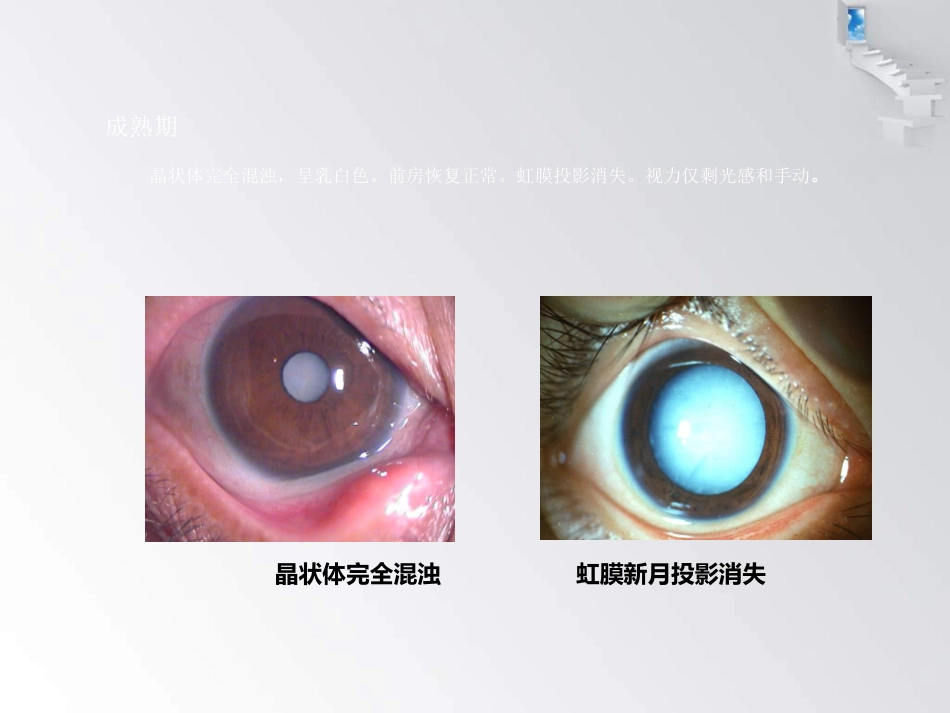 白内障护理查房 (1)_第15页
