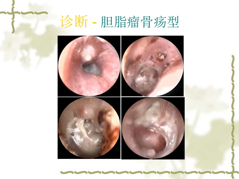 慢性中耳炎(1)_第12页