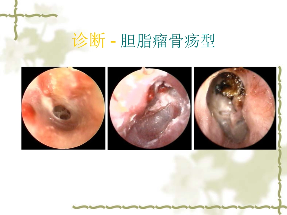 慢性中耳炎(1)_第13页