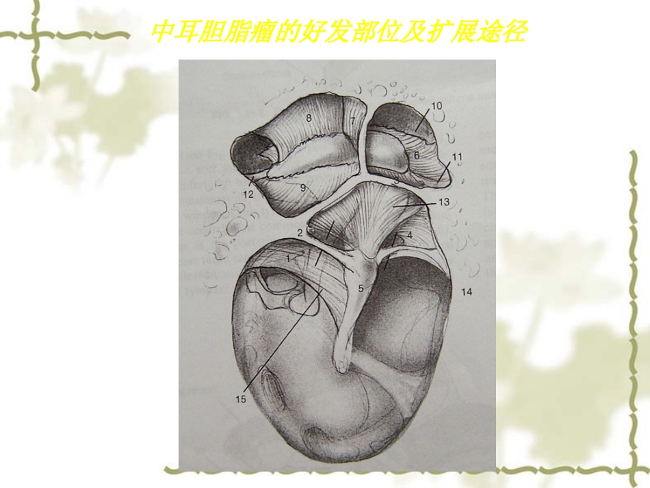 慢性中耳炎(1)_第14页