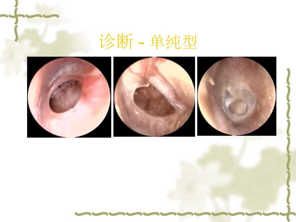 慢性中耳炎(1)_第9页