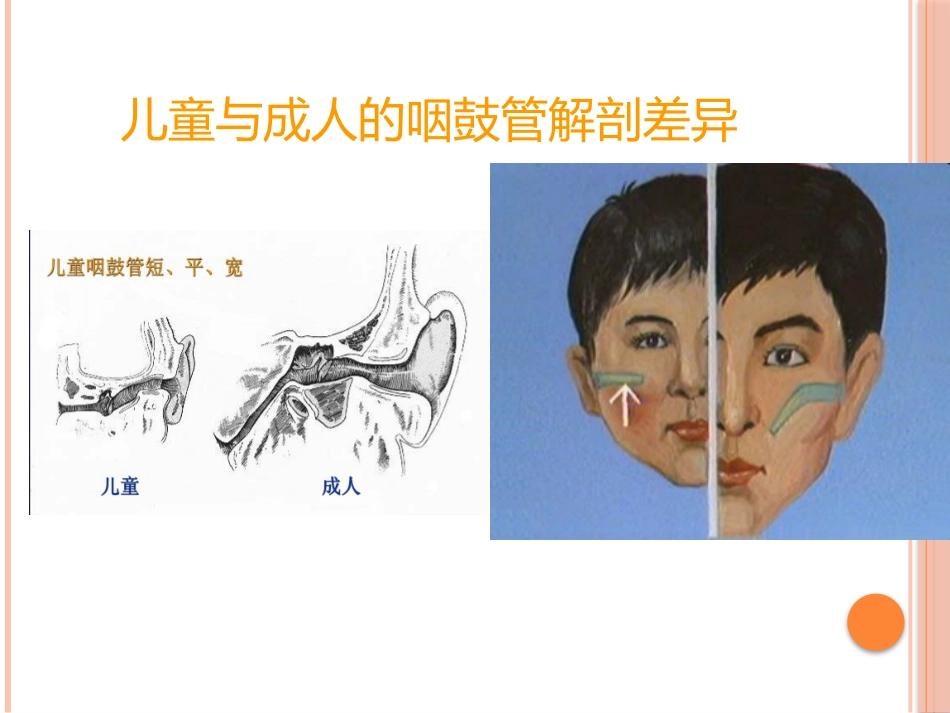 急性中耳炎(1)_第12页
