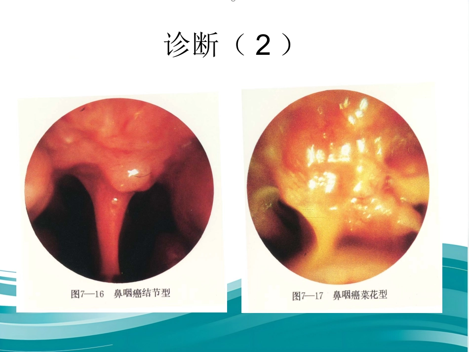 鼻咽癌(1)_第12页