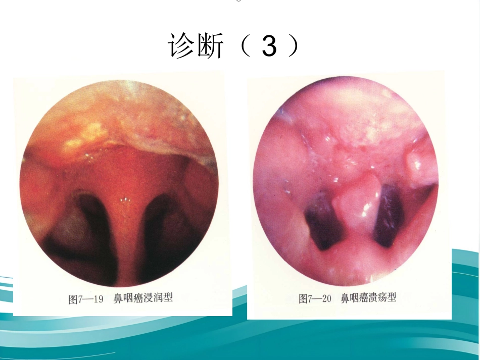 鼻咽癌(1)_第13页