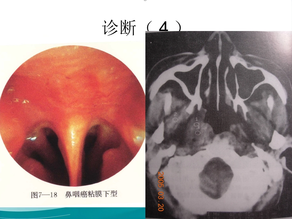 鼻咽癌(1)_第14页