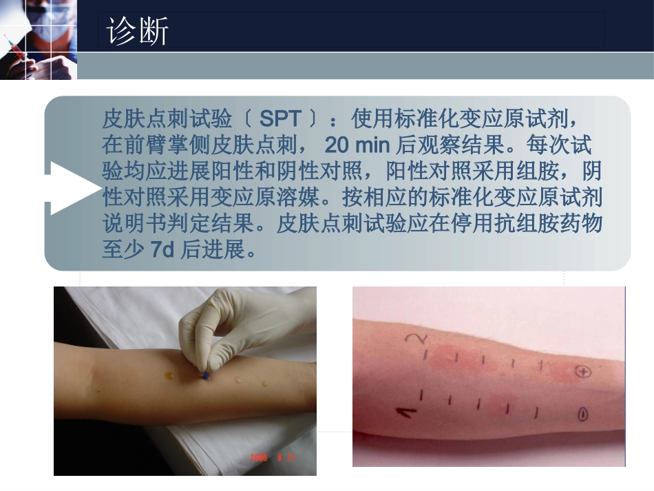 变应性鼻炎(1)_第15页