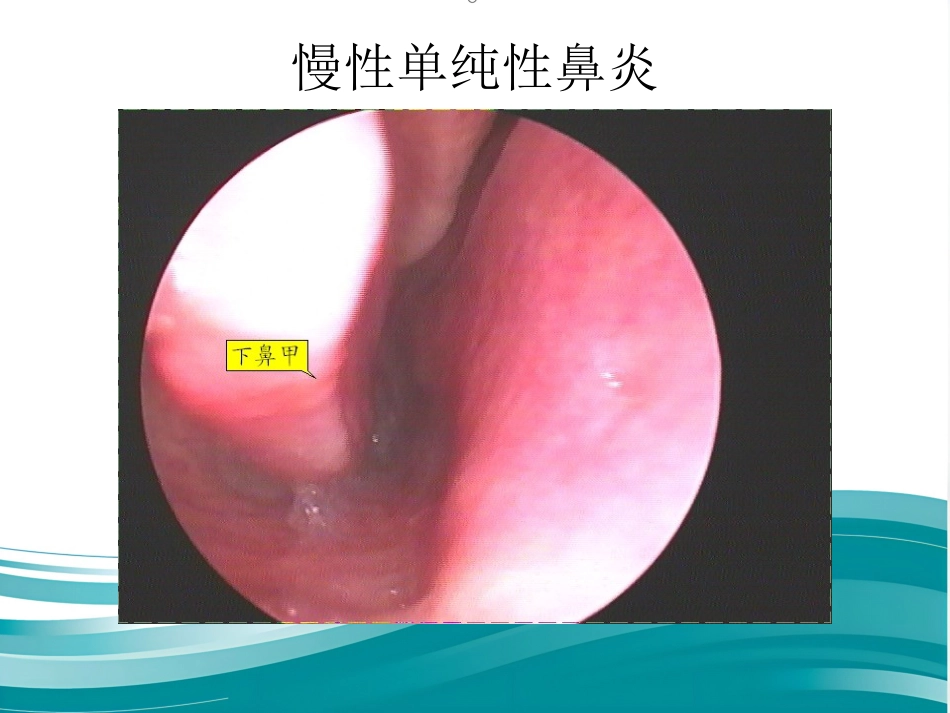 慢性鼻炎(1)_第10页