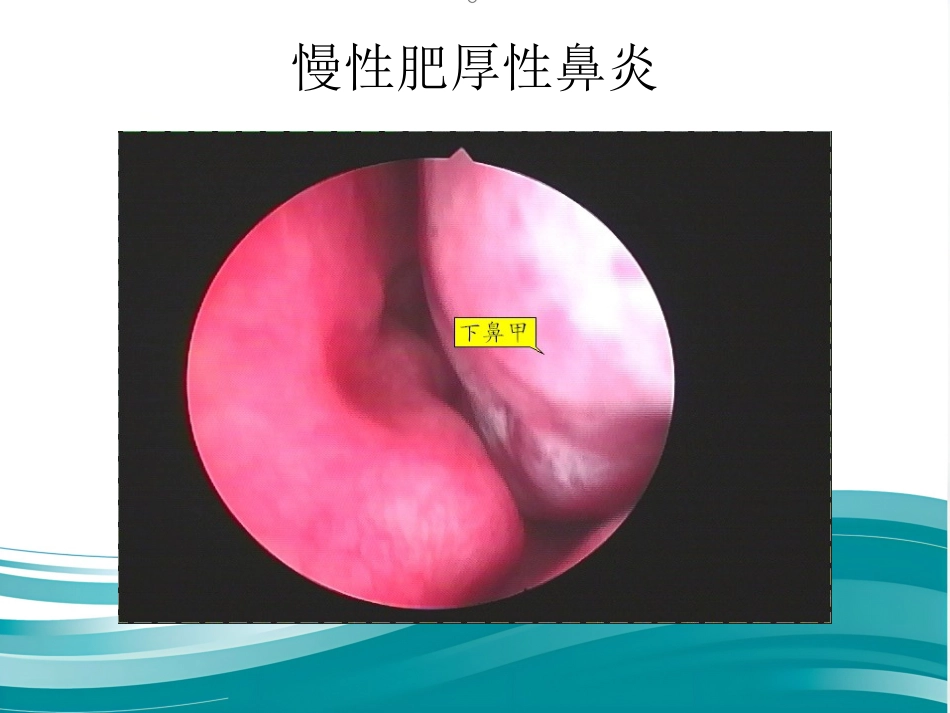 慢性鼻炎(1)_第11页