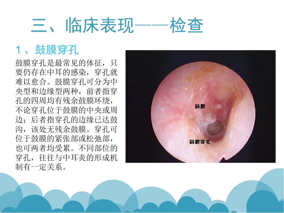 慢性化脓性中耳炎(1)_第5页