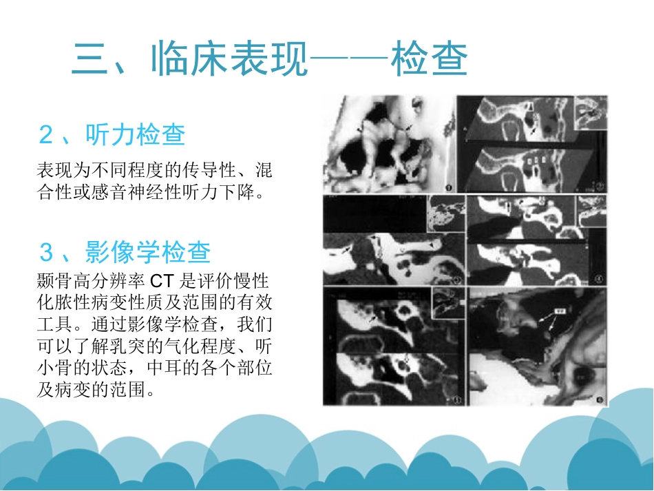慢性化脓性中耳炎(1)_第6页