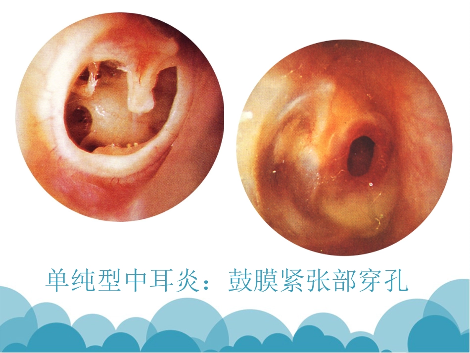 慢性化脓性中耳炎(1)_第9页