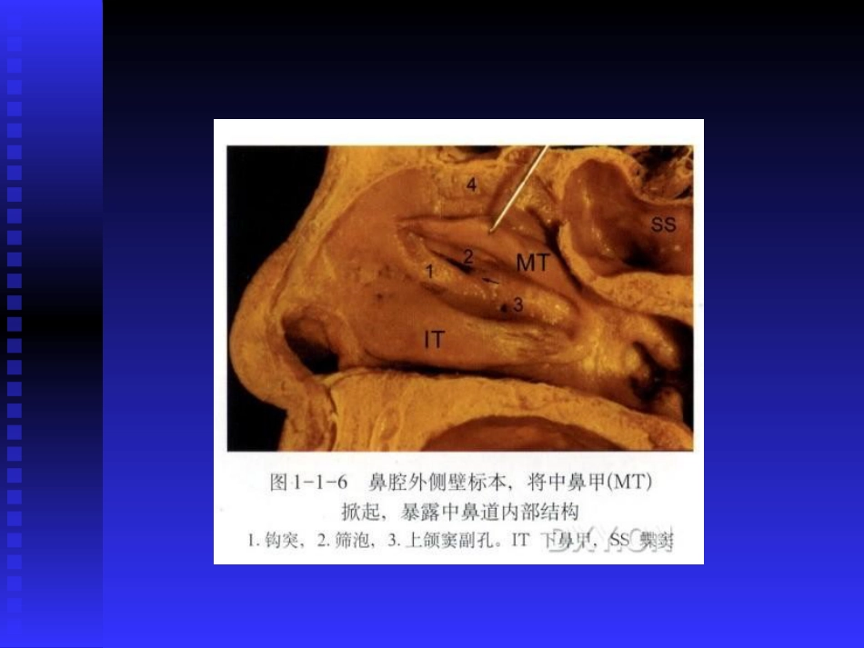 慢性鼻窦炎课件(1)_第10页