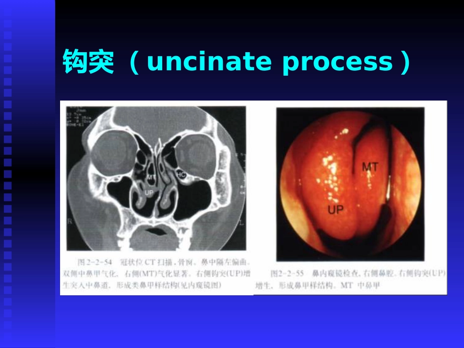 慢性鼻窦炎课件(1)_第11页