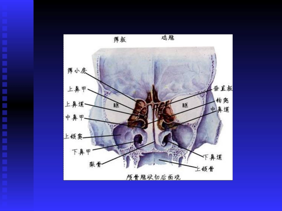 慢性鼻窦炎课件(1)_第12页