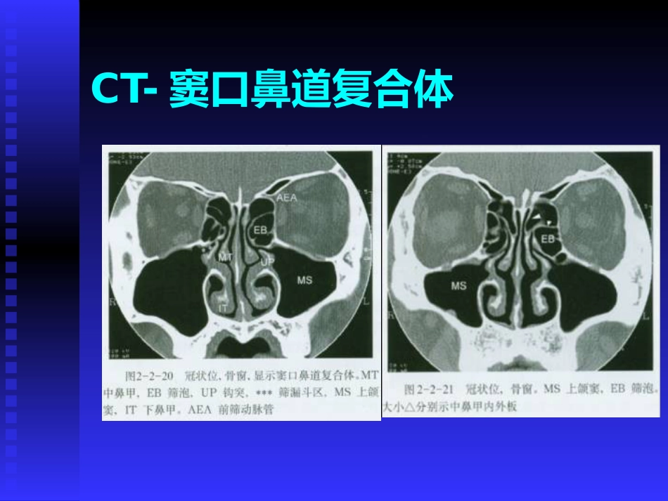 慢性鼻窦炎课件(1)_第7页