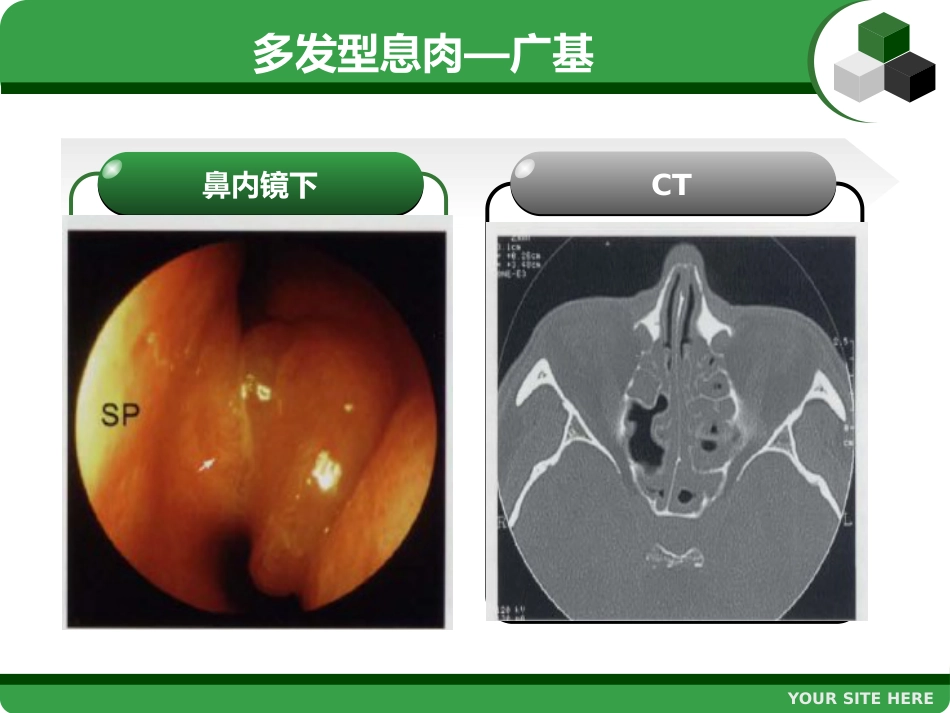 鼻息肉 (2)_第10页