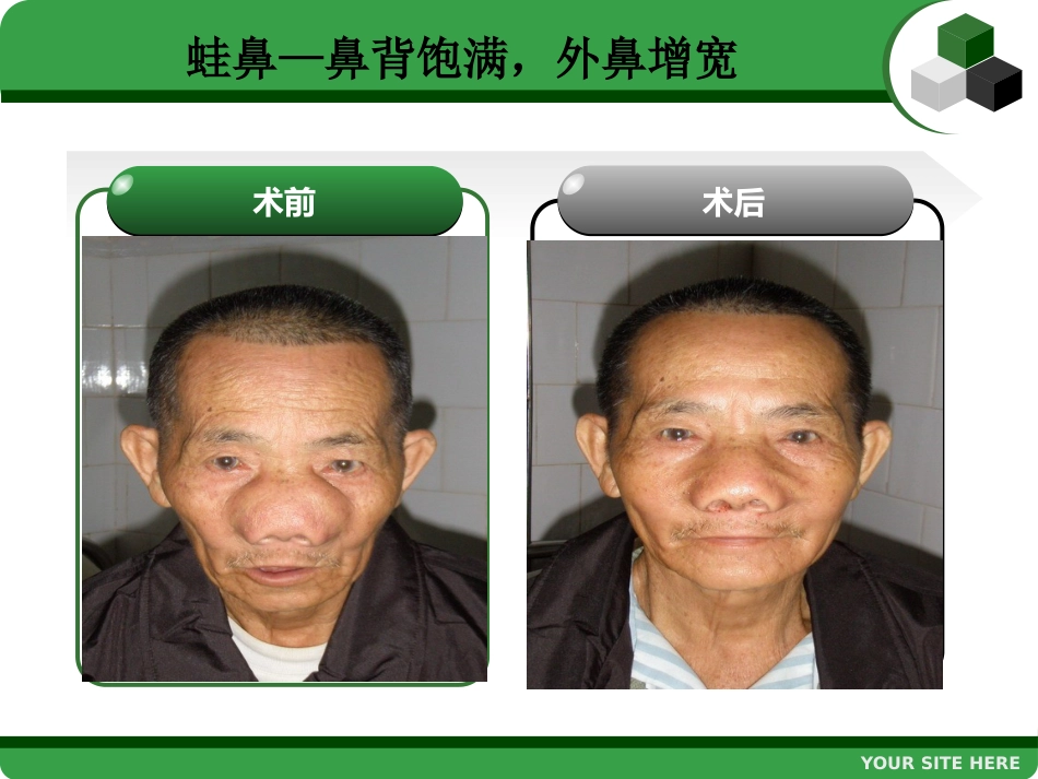鼻息肉 (2)_第11页