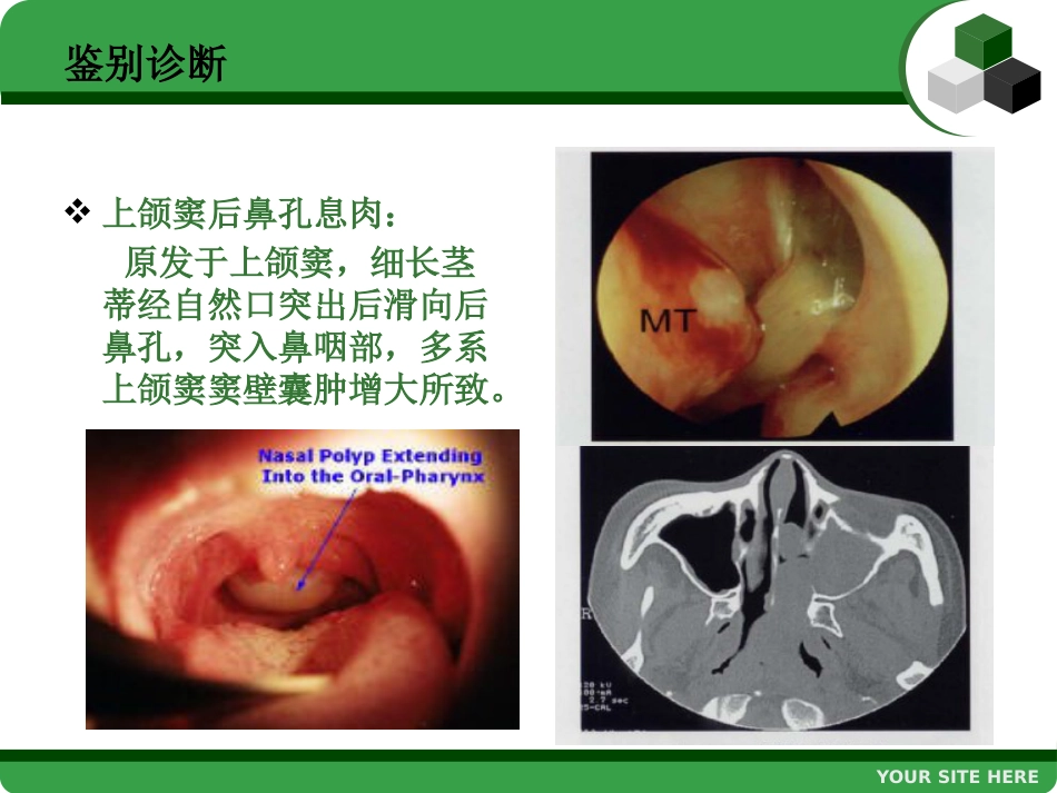鼻息肉 (2)_第15页