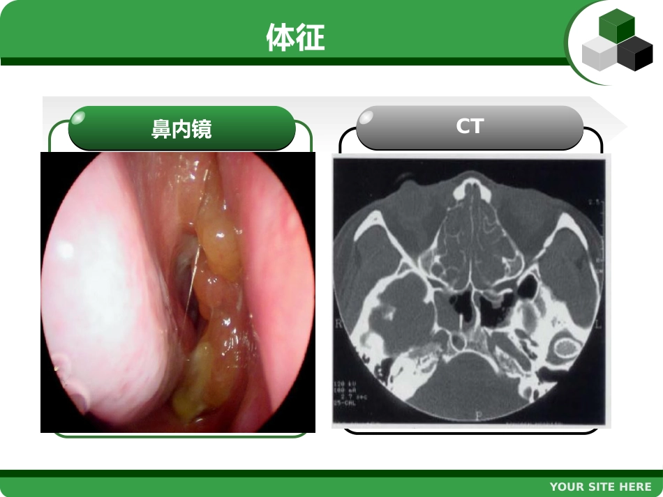 鼻息肉 (2)_第8页