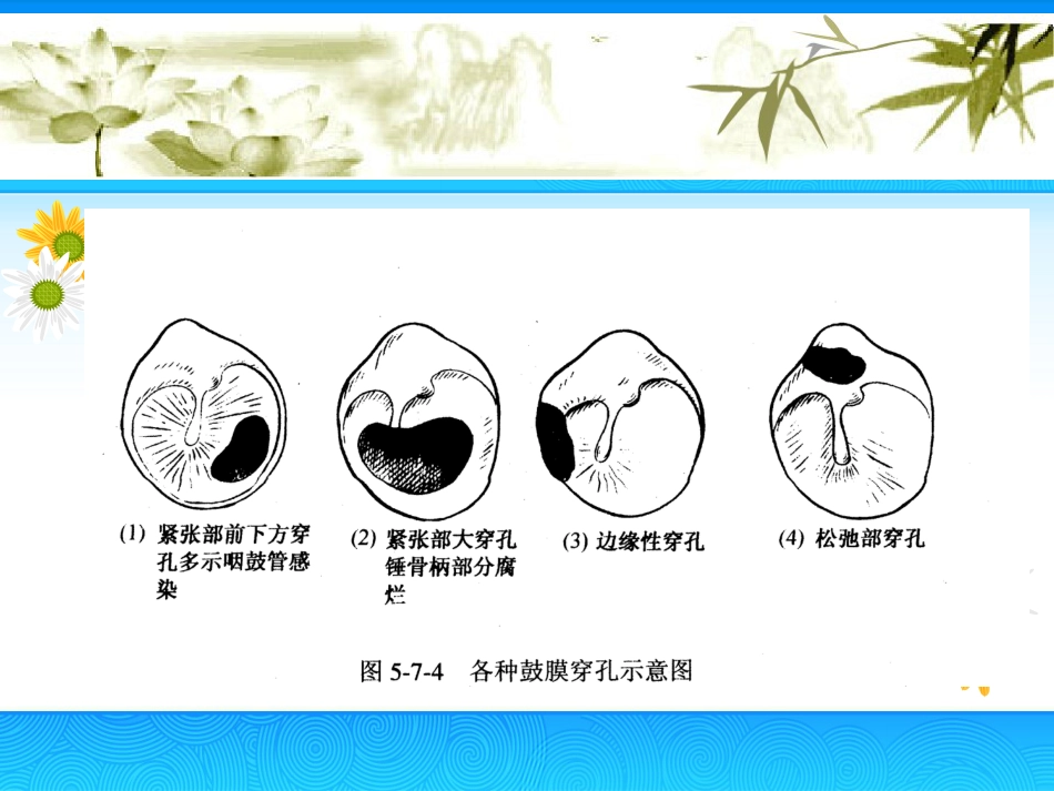 慢性中耳炎(2)_第15页