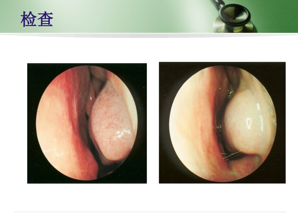 变应性鼻炎(2)_第12页