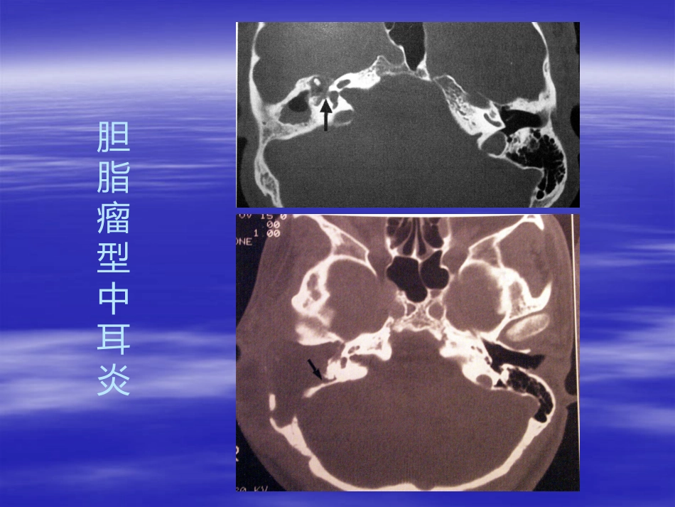 慢性化脓性中耳炎(3)_第11页