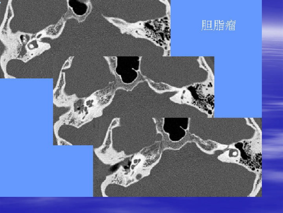 慢性化脓性中耳炎(3)_第12页