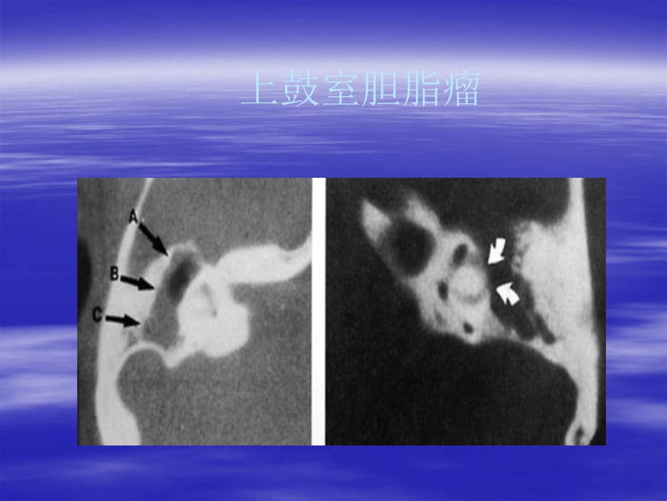 慢性化脓性中耳炎(3)_第14页