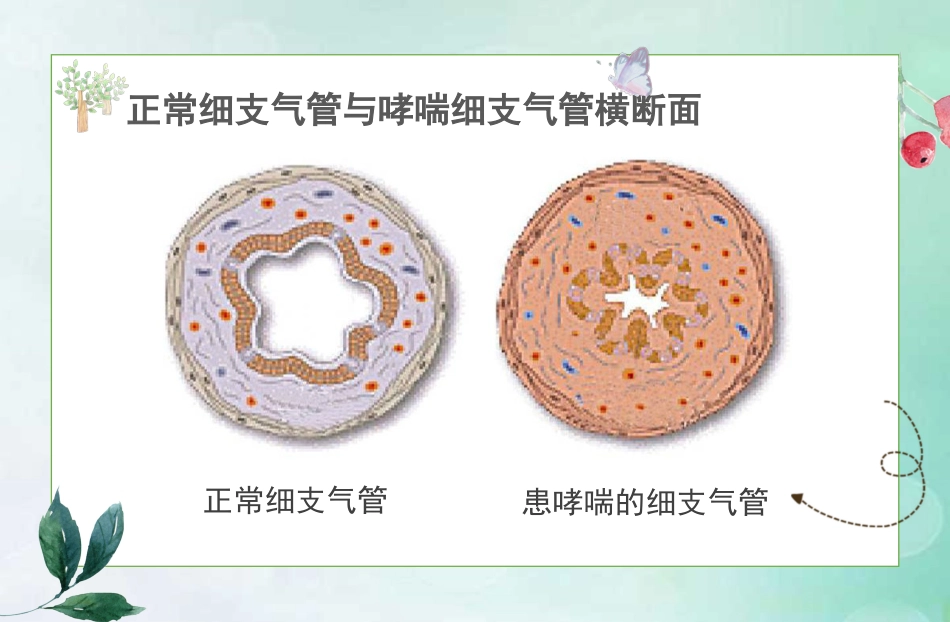 儿童哮喘的防与治5_第8页