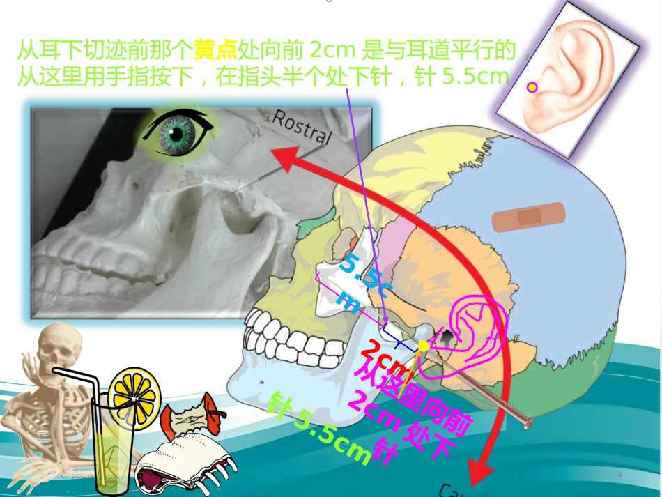 鼻炎 3 穴 讲解精编版_第4页