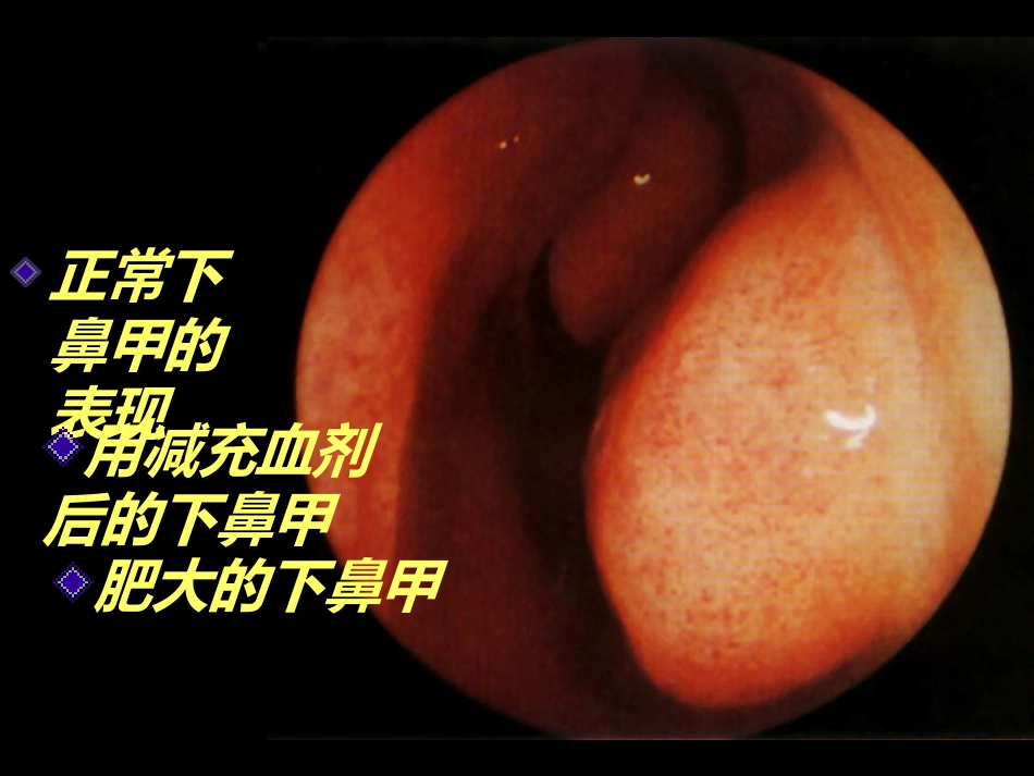 慢性鼻炎(3)_第6页