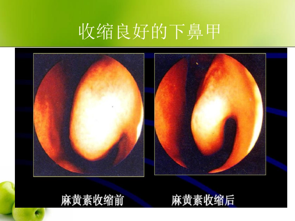 慢性鼻炎(3)_第7页