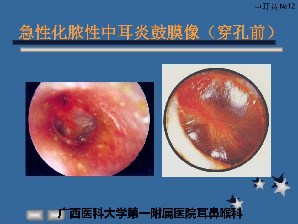 急性化脓性中耳炎(3)_第12页