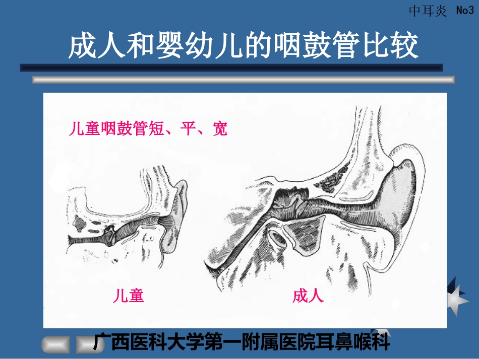 急性化脓性中耳炎(3)_第3页