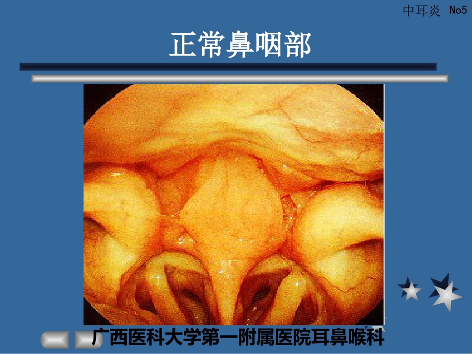 急性化脓性中耳炎(3)_第5页