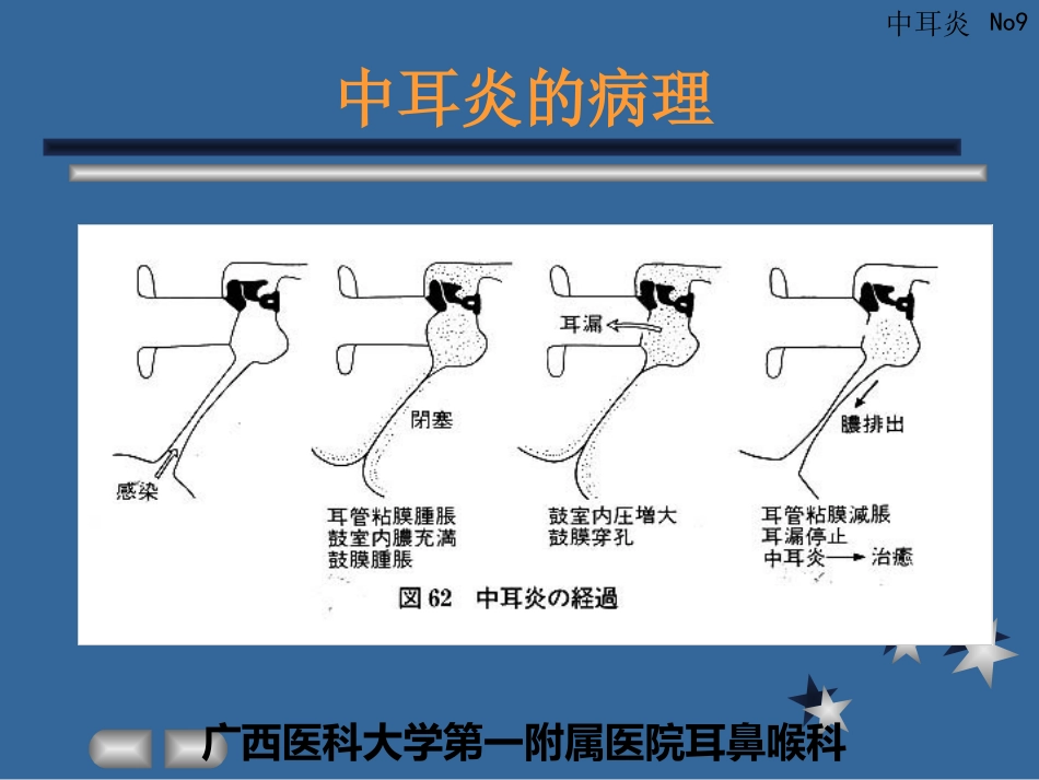 急性化脓性中耳炎(3)_第9页