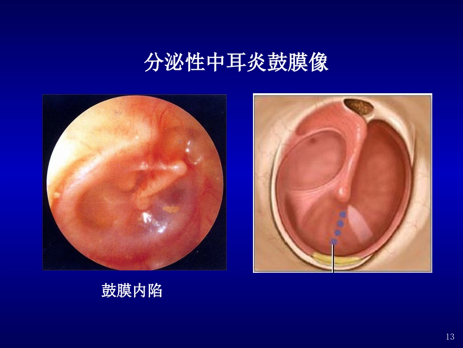 分泌性中耳炎(4)_第13页