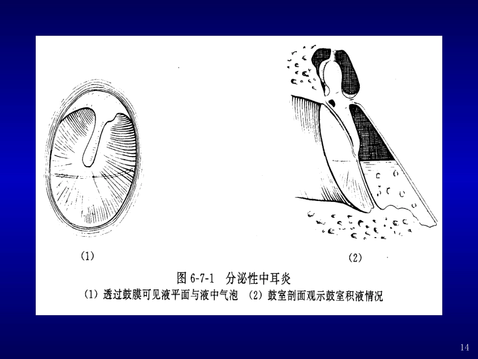 分泌性中耳炎(4)_第14页