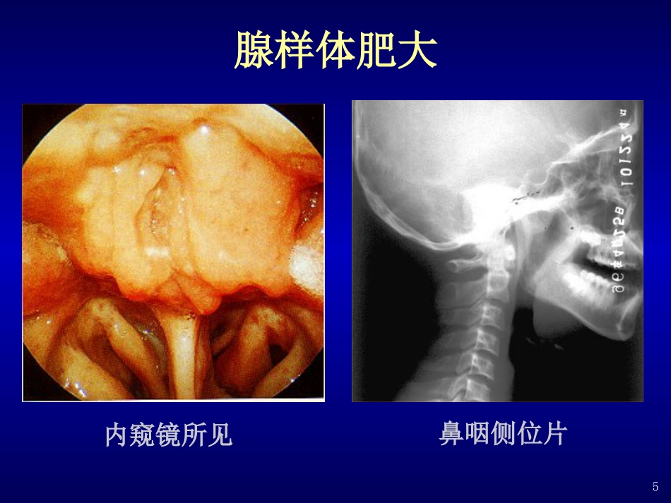 分泌性中耳炎(4)_第5页