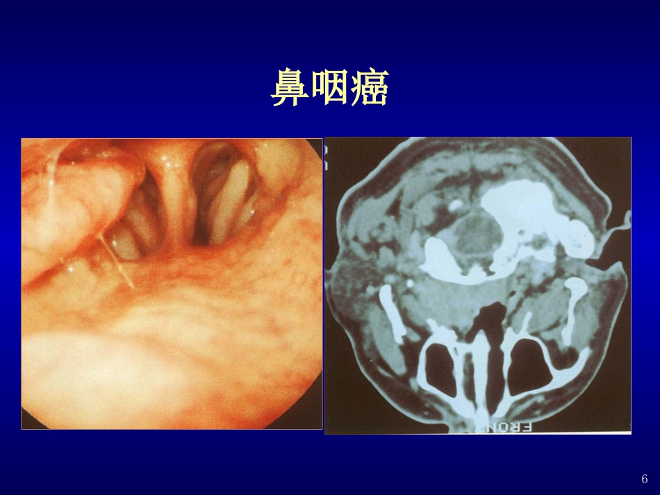 分泌性中耳炎(4)_第6页