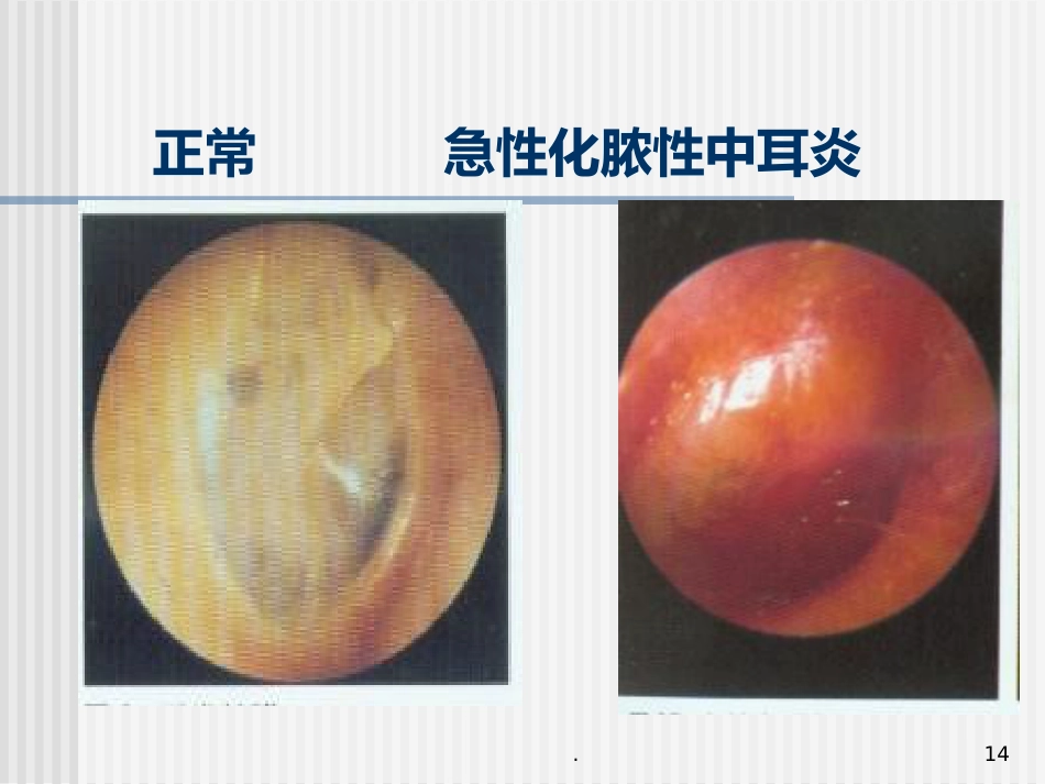 急性化脓性中耳炎(5)_第14页
