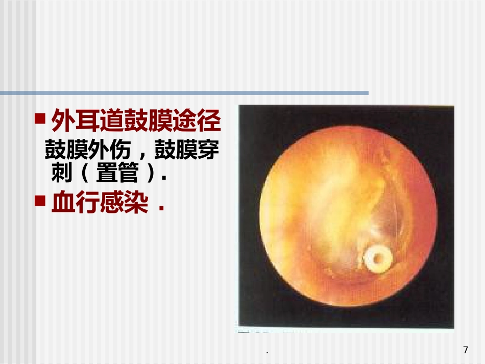 急性化脓性中耳炎(5)_第7页