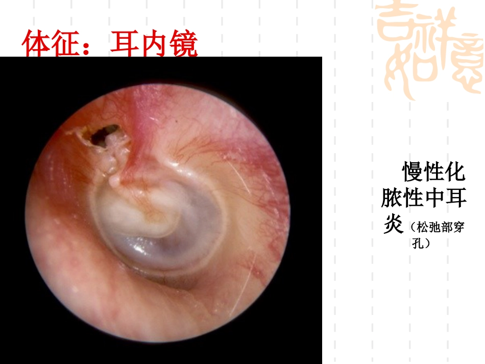慢性化脓性中耳炎(5)_第11页
