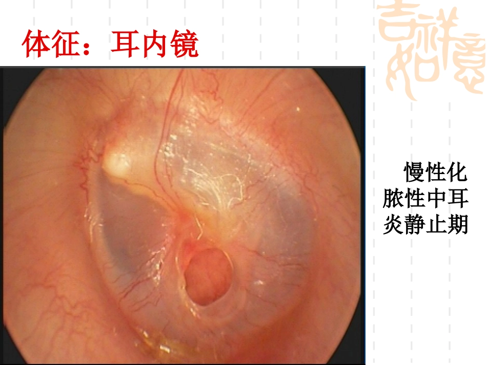 慢性化脓性中耳炎(5)_第6页