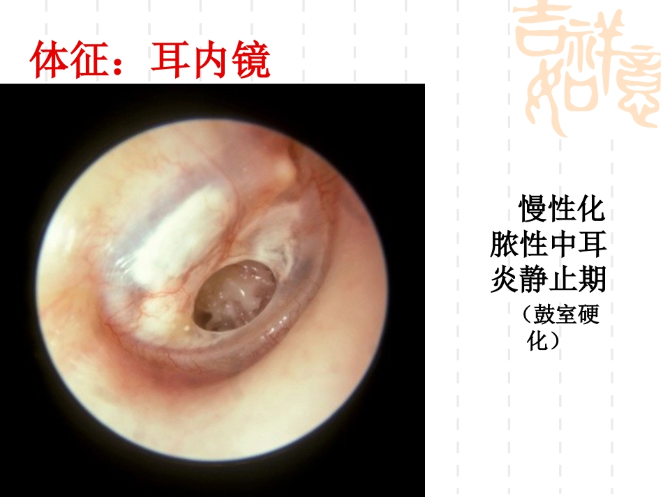 慢性化脓性中耳炎(5)_第7页